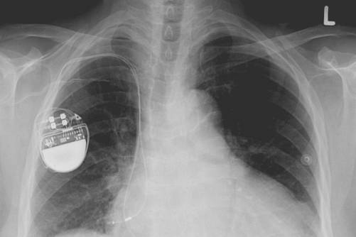 Beültetett pacemaker mellkasi röntgenfelvételen