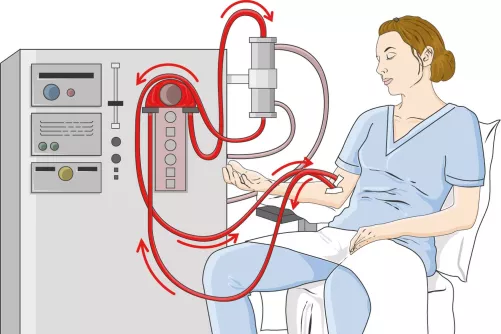 Művesekezelés sematikusan