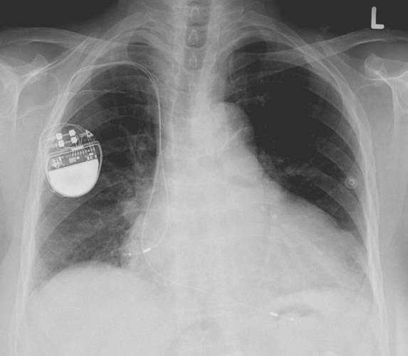 Beültetett pacemaker