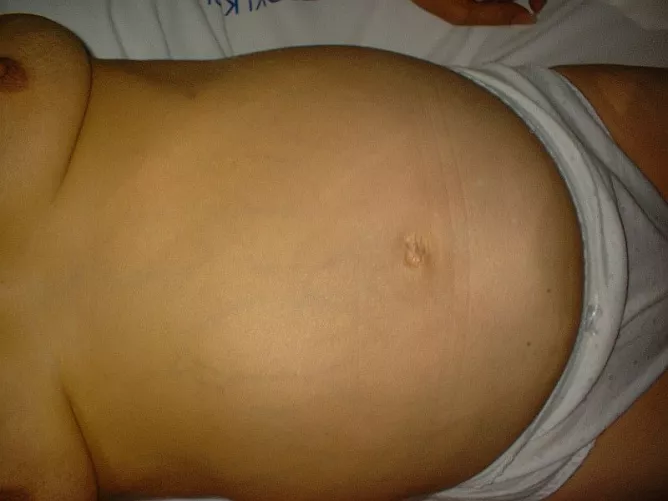 A bőr sárgás elszíneződése májelégtelenségben.