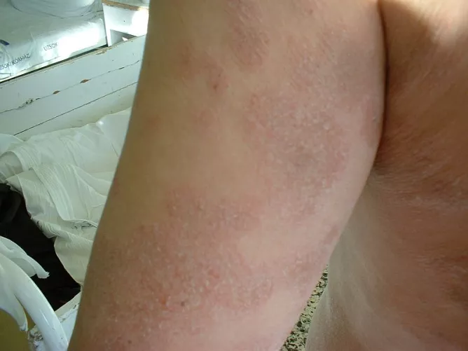 Bőrgombásodás és gyulladás