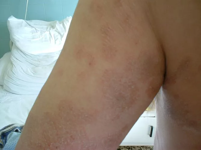 Bőrgombásodás és gyulladás