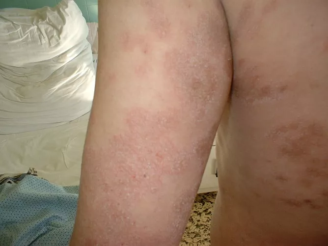 Bőrgombásodás és gyulladás