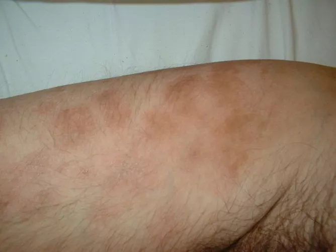 Bőrgombásodás és gyulladás