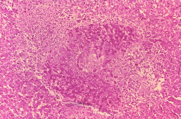 Brucella granuloma májban