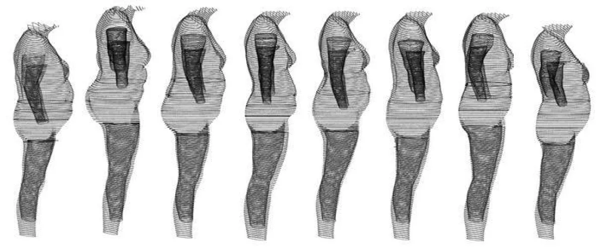 Elhízási típusok (nők)