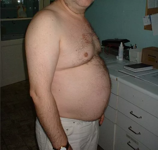 Férfias típusú, hasra lokalizálódó elhízás