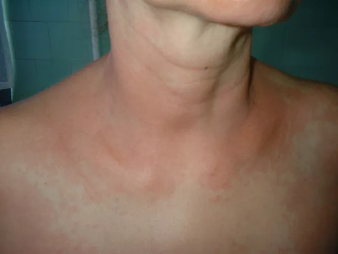 Gyógyszerallergia bőrtünete