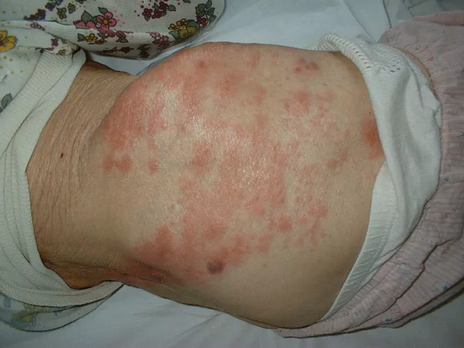 Gyógyult övsömör