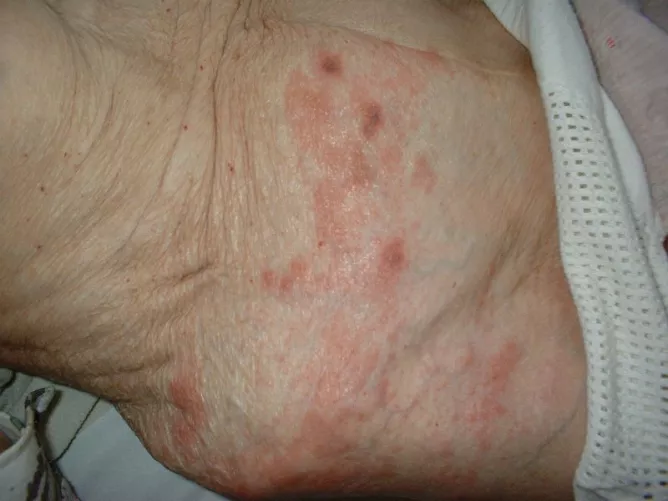 Gyógyult övsömör