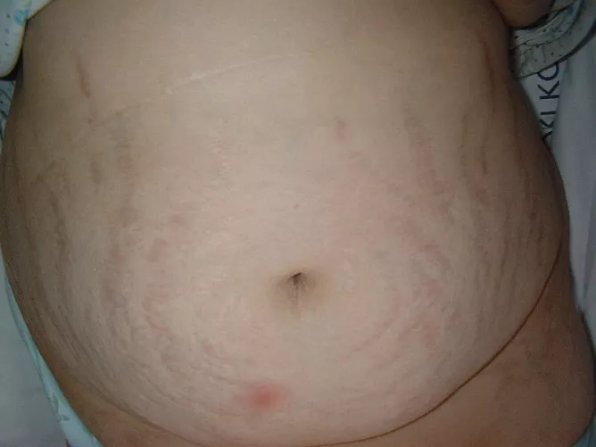 Hasfali striák, szteroidtúladagolás következtében.