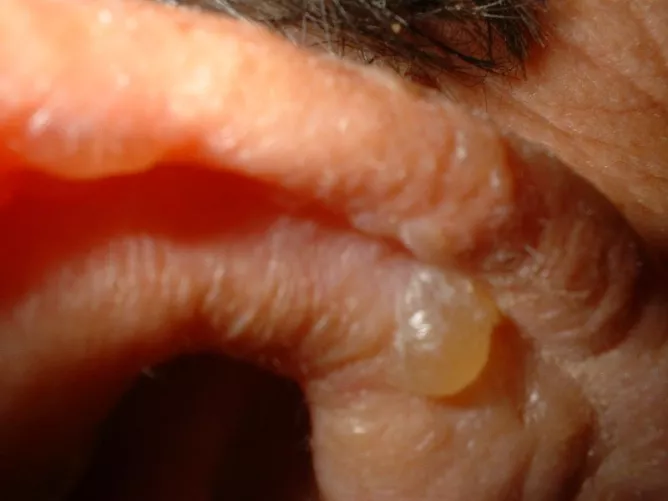 Herpeszes hólyag a fülön.