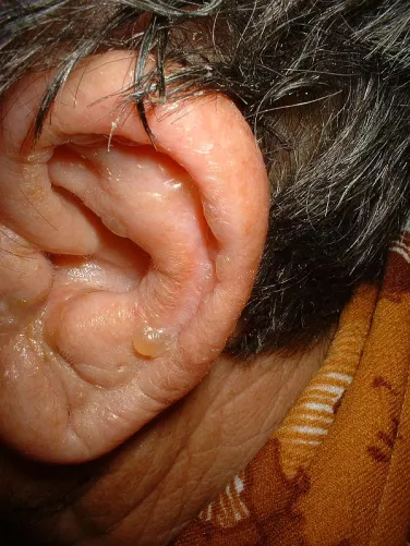 Herpeszes hólyag a fülön.