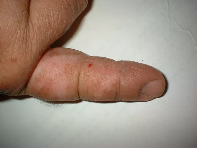 Idült bőrgyulladás a jobb mutatóujjon.