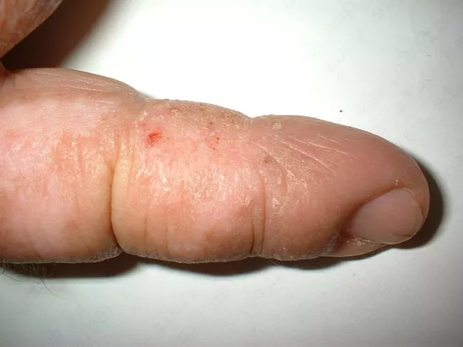 Idült bőrgyulladás a bal kéz mutatóujján.