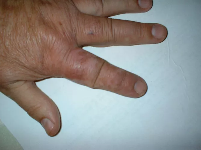 Idült bőrgyulladás a bal kéz mutatóujján.