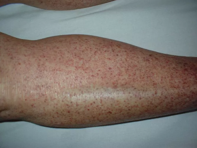 Immun thrombocytopéniás purpura