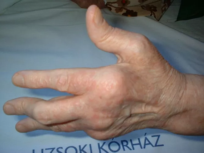 A kéz kisízületeinek deformitása pikkelysömör következtében
