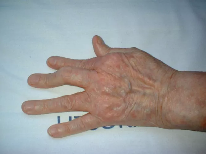 A kéz kisízületeinek deformitása pikkelysömör következtében