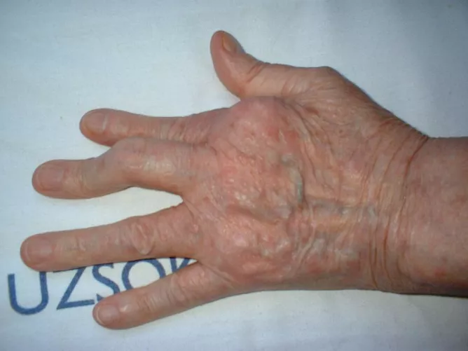 A kéz kisízületeinek deformitása pikkelysömör következtében