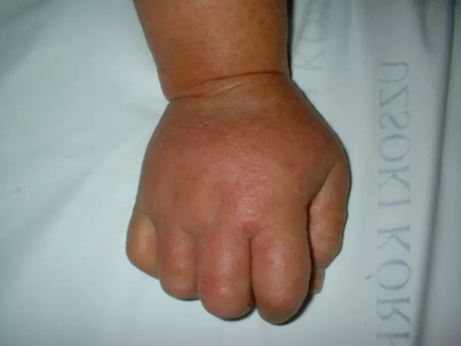 Kontakt bőrgyulladás