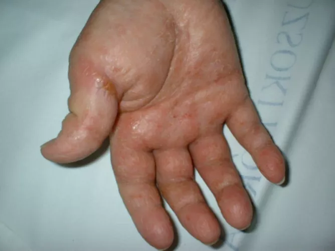 Kontakt bőrgyulladás