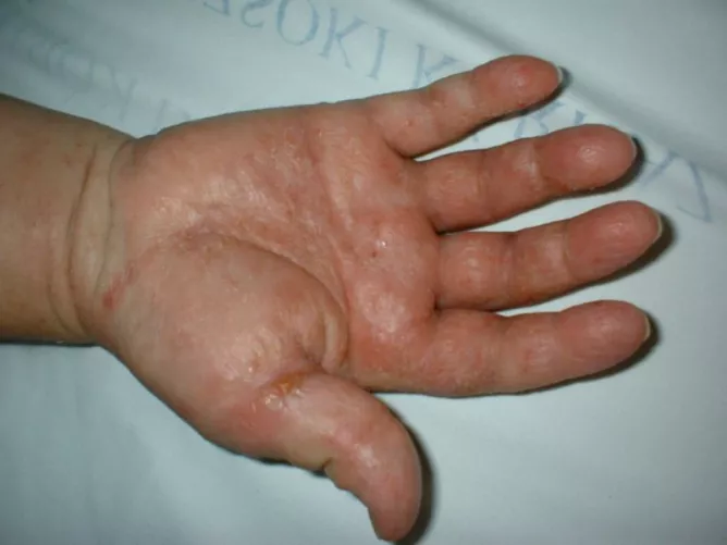 Kontakt bőrgyulladás