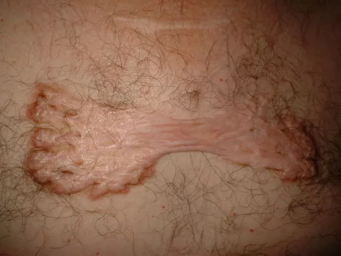 Kóros sebgyógyulás eredménye: keloid.