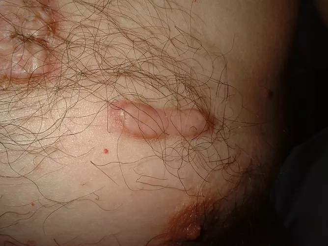 Kóros sebgyógyulás eredménye: keloid.