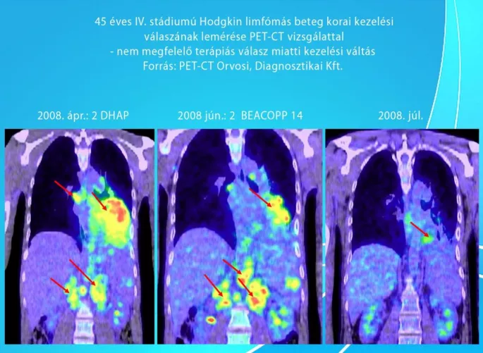 45 éves, IV. stádiumú Hodgkin limfómás beteg korai kezelési válaszának lemérése PET-CT vizsgálattal. Nem megfelelő terápiás válasz okán váltott kezelés.