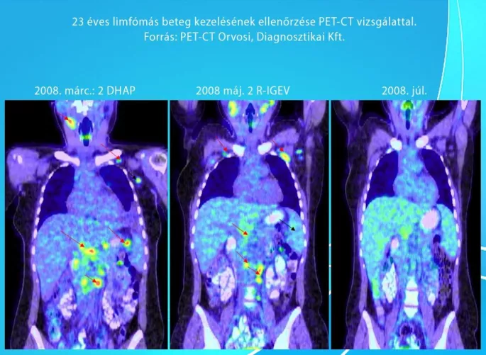 23 éves limfómás beteg kezelésének ellenőrése PET-CT vizsgálattal.