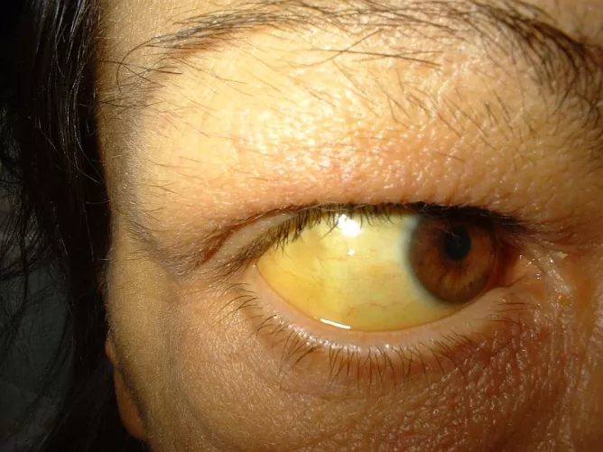 A szem ínhártyájának sárga elszíneződése májelégtelenségben.