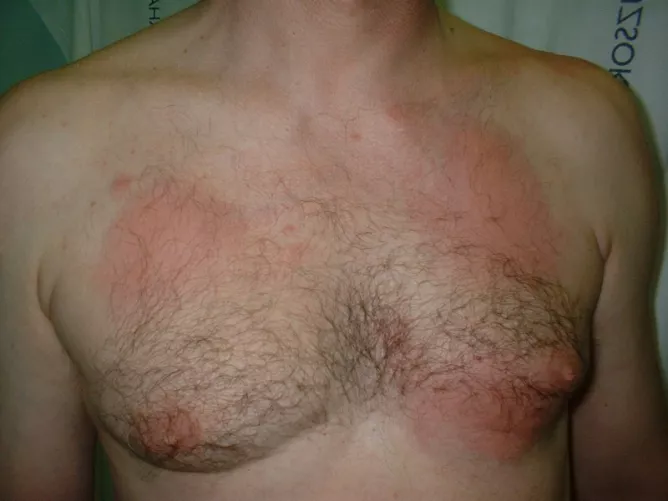 Méhcsípések a mellkason