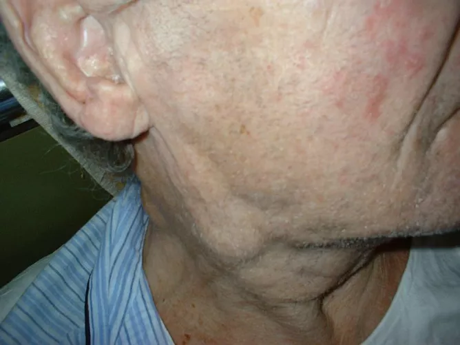 Nyirokcsomóduzzanat