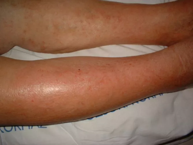 Orbánc a jobb lábszáron