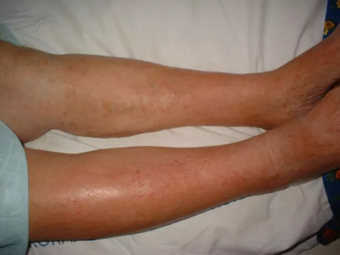 Orbánc a jobb lábszáron