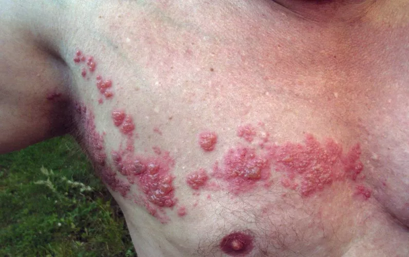 Övsömör (psoriasis vulgaris) mellkason