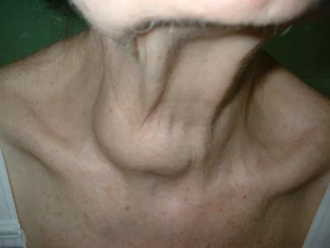 A pajzsmirigy jobb lebenyének megnagyobbodása