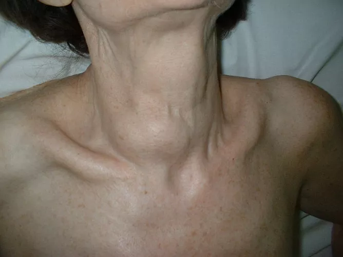 A pajzsmirigy jobb lebenyének megnagyobbodása