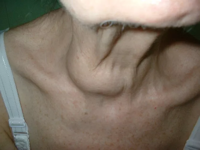 A pajzsmirigy jobb lebenyének megnagyobbodása