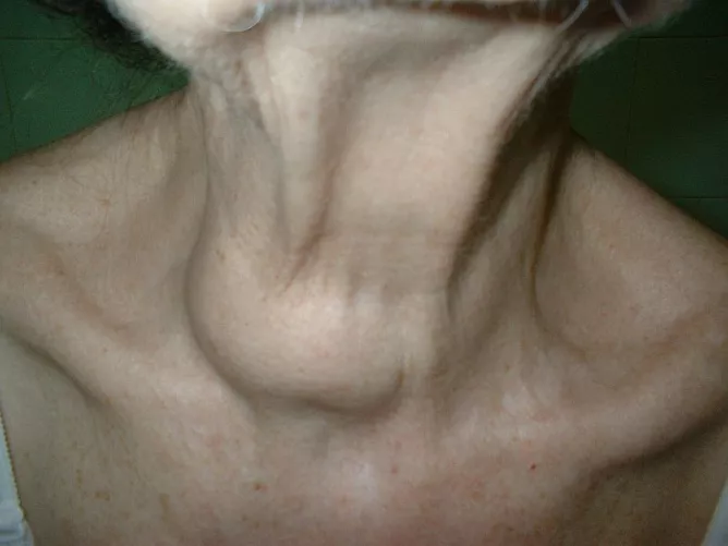 A pajzsmirigy jobb lebenyének megnagyobbodása