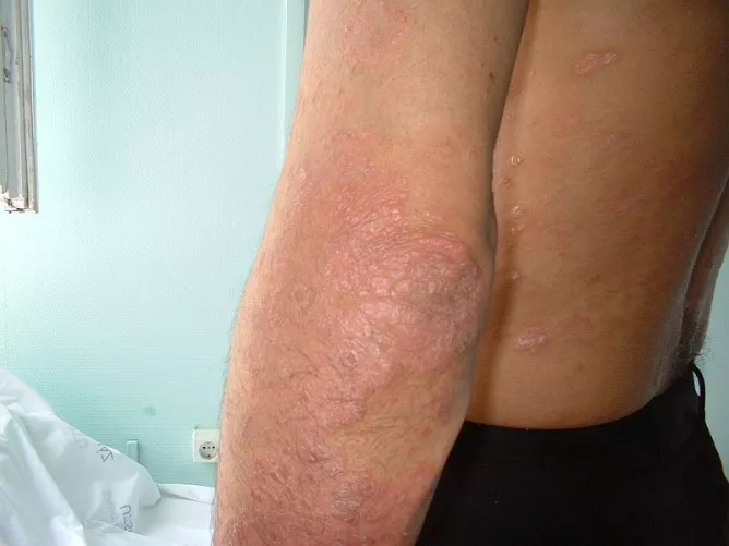 Pikkelysömör a bal könyökön