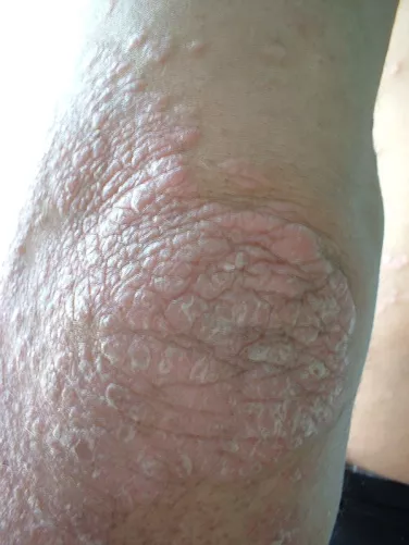 Pikkelysömör a bal könyökön