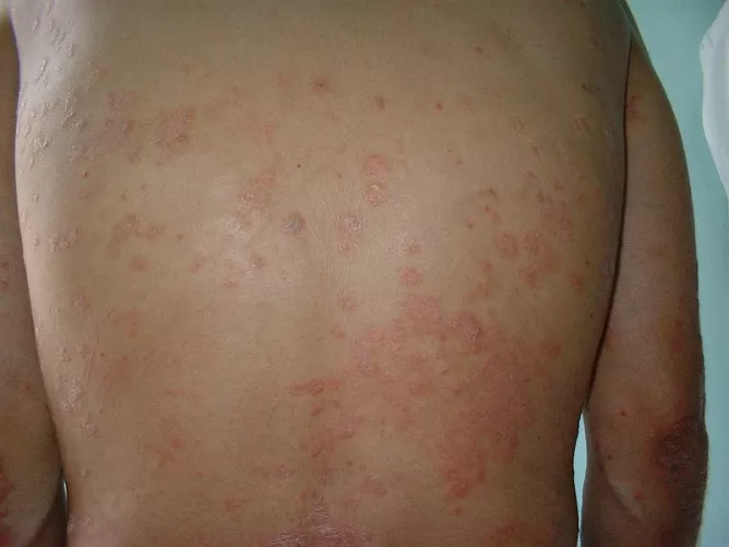 Pikkelysömör a háton.