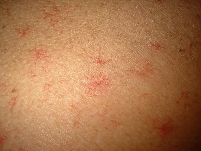 Pók alakú értágulatok a bőrön májbetegségben