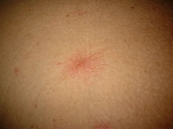 Pók alakú értágulatok a bőrön májbetegségben