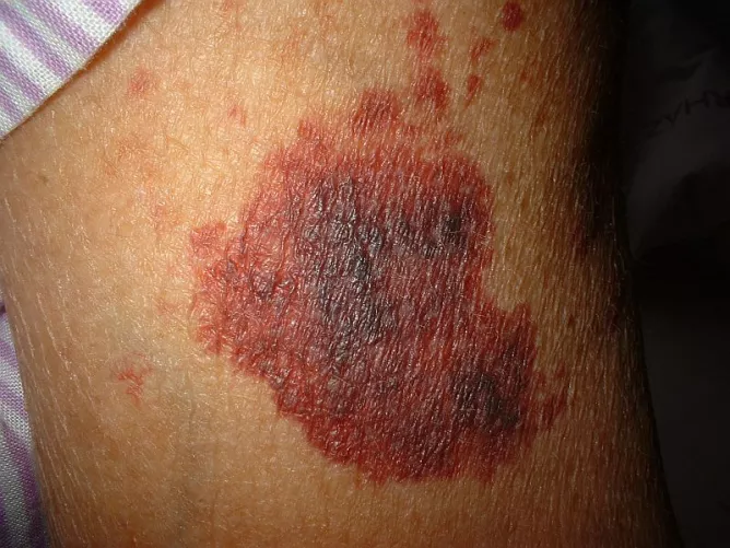 Spontán bőrvérzés májelégtelenségben.