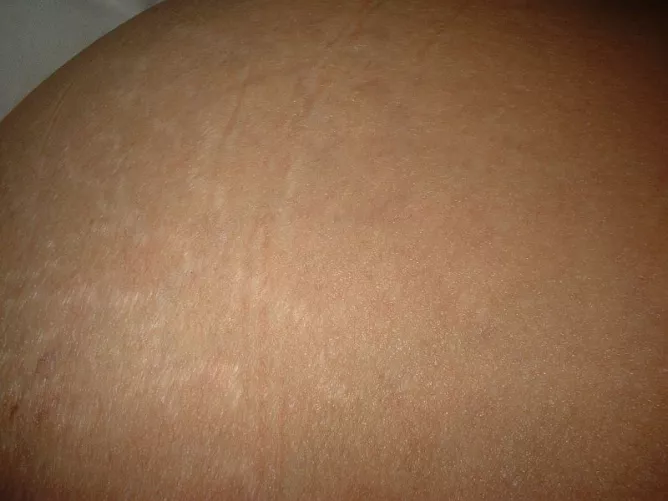 Striák a has bőrén