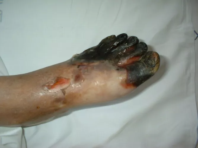 Száraz üszkösödés