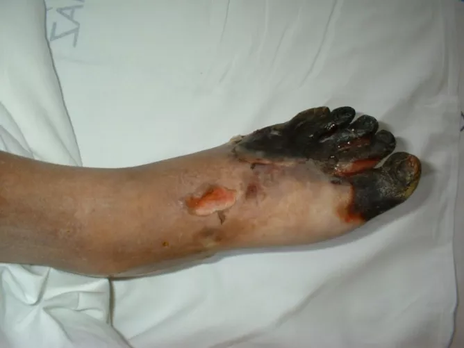 Száraz üszkösödés